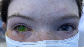 Austrália tem aumento do número de casos de doença que causa olhos verdes e dor equivalente à de parto