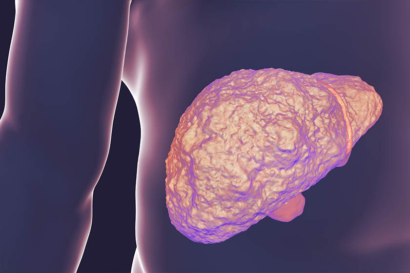 Esteatose hepática: evite problema no fígado | Metrópoles