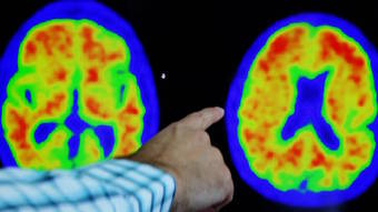 Vacina em testes tem potencial para revolucionar o curso da doença de Alzheimer