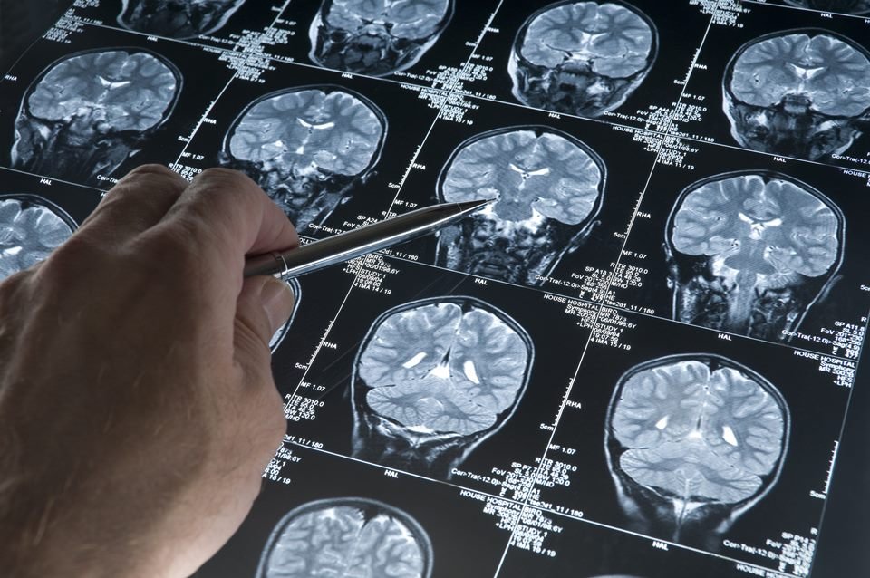 Alzheimer: estudo traz novas pistas sobre causas da doença