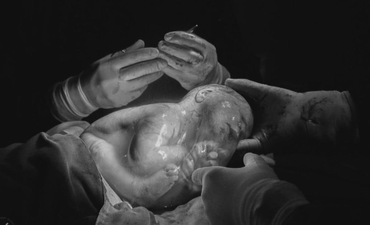 Empelicado: Em fenômeno raro, bebê nasce dentro da bolsa amniótica da mãe; veja | CNN Brasil
