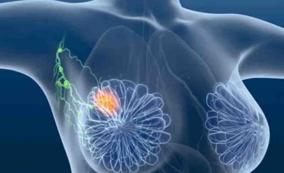 Médicos descobrem novo tratamento para câncer de mama agressivo - Só Notícia Boa