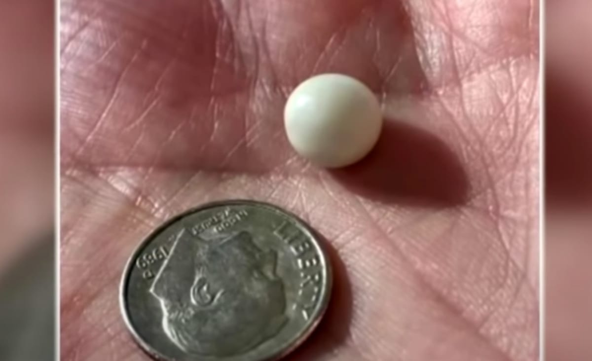 Couple Finds Large Pearl Worth Thousands After Ordering Clams on 34th Anniversary With Favorite Restaurant