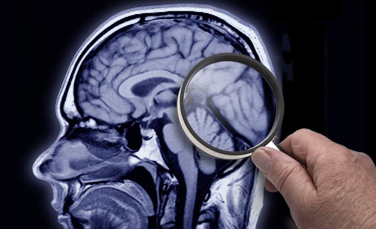 Maioria das pessoas não conhece os sintomas de Alzheimer precoce, diz pesquisa | CNN Brasil