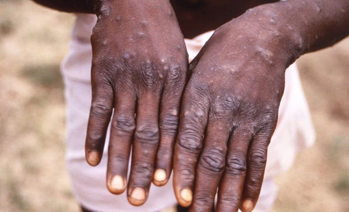 ‘Urgency’: WHO expects more monkeypox cases globally