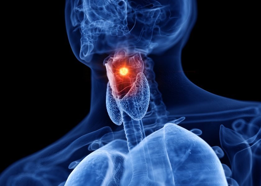 Câncer de laringe: saiba quais são os sintomas | Metrópoles